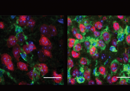 Huntingon's disease genomics