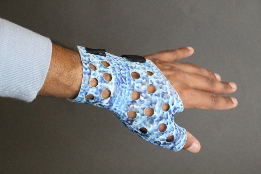 A person’s arm wearing a 3D-printed wrist-protecting cast that is textured, blue, and has holes.