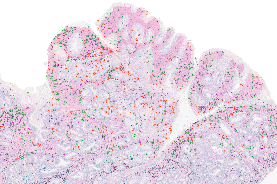 In this colon tumor, which has a mutation that gives it a high degree of DNA mismatch repair deficiency, T cells (labeled black, green, and red) have accumulated primarily in the supportive tissues (pink regions), while very few have infiltrated tumor cells (islands surrounded by the supportive tissues).