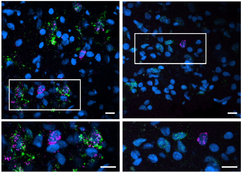 An analysis of human brain samples ooking for factors associated with neural vulnerability and cognitive resilience amid Alzheimer's disease (Credit: Tsai Lab/The Picower Institute).