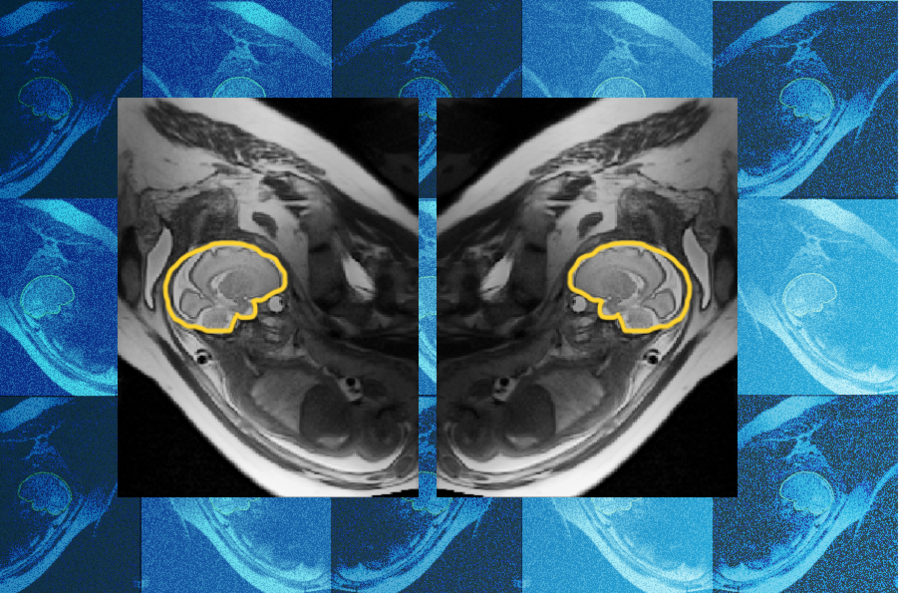 An MRI scan of a fetal brain (outlined in yellow) in the sagittal position. E(3)-Pose is a model that helps track movement in an MRI of the fetus’s brain. The model could help clinicians make earlier and more accurate diagnoses of developmental anomalies (Credits: Courtesy of the MIT Jameel Clinic and the researchers).